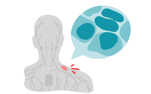 Die Illustration zeigt das lymphatischen System eines Menschens und die mutierten Lymphozyten. Das Bild beschreibt die Blutkrebsart Lymphom.